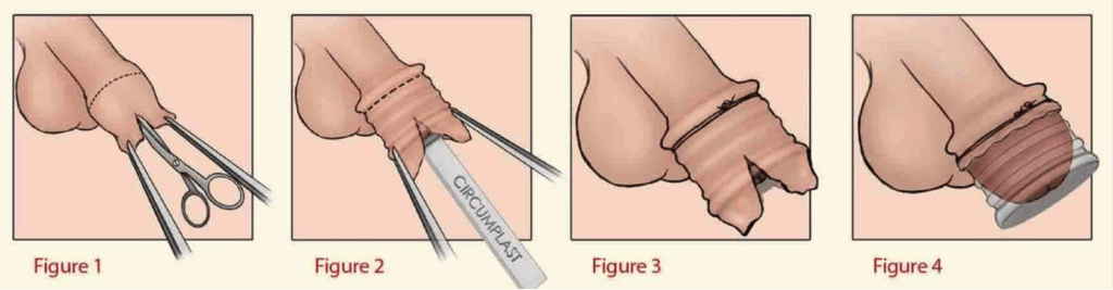 Infant or Boy Circumcision Device