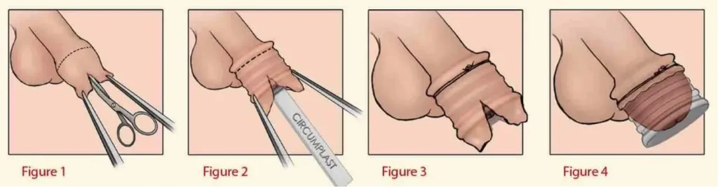 Infant or Boy Circumcision Device
